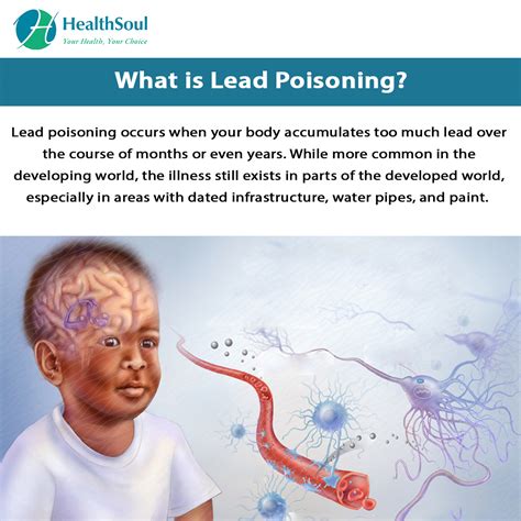 Can you get lead poisoning from touching lead?